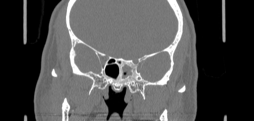 Chronic sphenoidal sinusitis (Radiopaedia 62030-70122 Coronal bone window 110).jpg