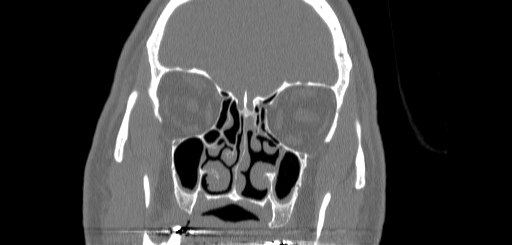 Chronic sphenoidal sinusitis (Radiopaedia 62030-70122 Coronal bone window 62).jpg