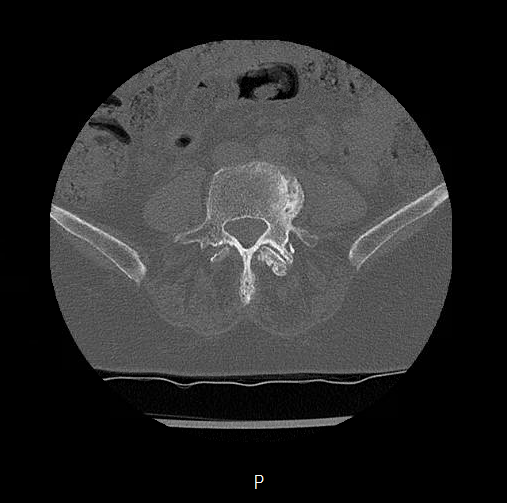 File:Chronic spinal hematoma with cauda equina syndrome (Radiopaedia 75745-88197 Axial bone window 52).png