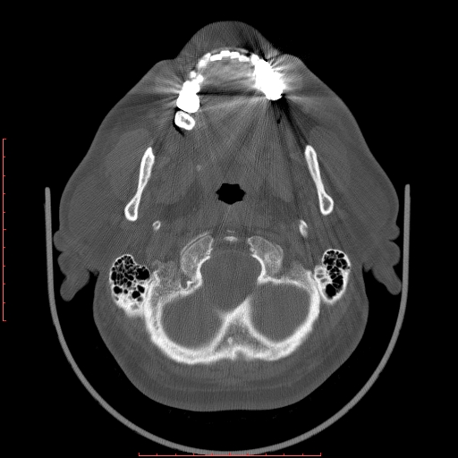 Chronic submandibular sialolithiasis (Radiopaedia 69817-79814 Axial bone window 14).jpg