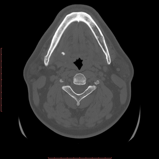 Chronic submandibular sialolithiasis (Radiopaedia 69817-79814 Axial bone window 72).jpg