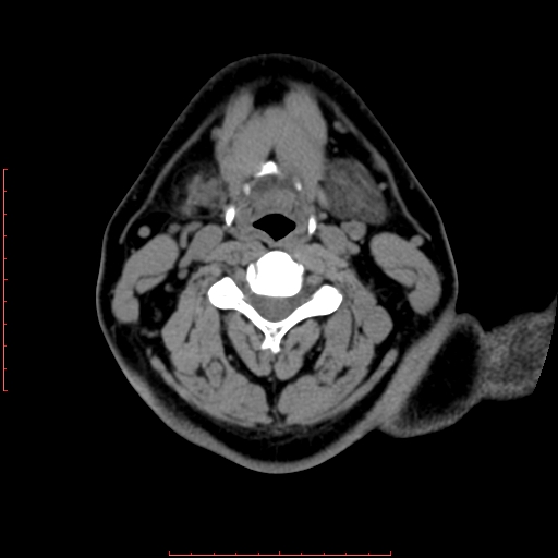 Chronic submandibular sialolithiasis (Radiopaedia 69817-79814 Axial non-contrast 135).jpg
