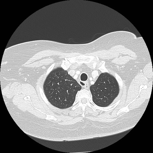 Cicatrisation collapse (Radiopaedia 17405-17089 lung window 18).jpg