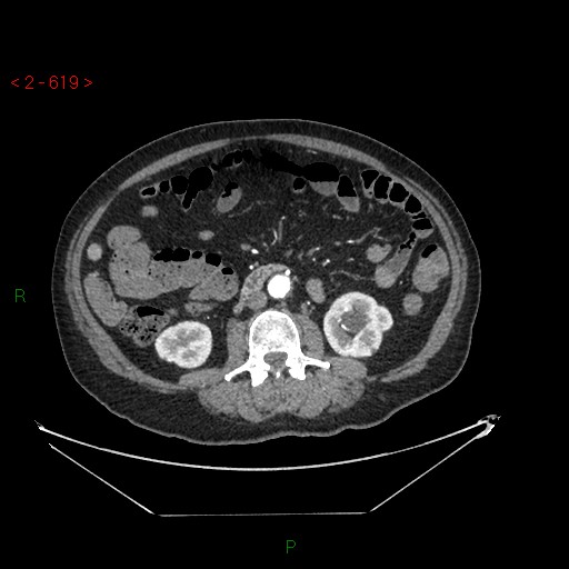 Circumaortic left renal vein and doubled left renal arteries (Radiopaedia 52268-58158 A 155).jpg