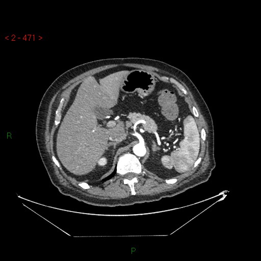 Circumaortic left renal vein and doubled left renal arteries (Radiopaedia 52268-58158 A 7).jpg