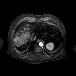 Cirrhosis and hepatocellular carcinoma in the setting of hemochromatosis (Radiopaedia 75394-86594 Axial T1 C+ fat sat 151).jpg