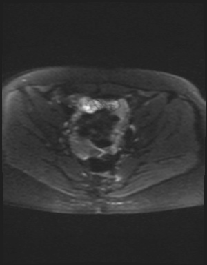 File:Class II Mullerian duct anomaly- unicornuate uterus with rudimentary horn and non-communicating cavity (Radiopaedia 39441-41755 Axial DWI 13).jpg