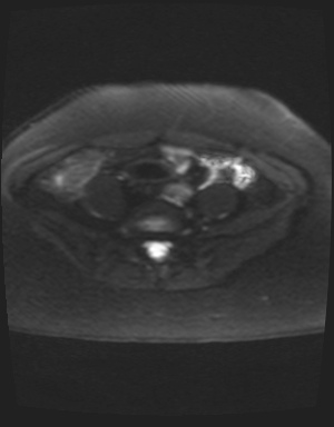 Class II Mullerian duct anomaly- unicornuate uterus with rudimentary horn and non-communicating cavity (Radiopaedia 39441-41755 Axial DWI 2).jpg