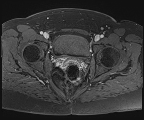 File:Class II Mullerian duct anomaly- unicornuate uterus with rudimentary horn and non-communicating cavity (Radiopaedia 39441-41755 Axial T1 fat sat 99).jpg