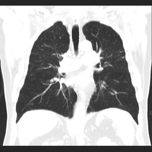 File:Classic complicated silicosis (Radiopaedia 49720-54961 Coronal lung window 34).jpg