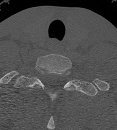 Clay-shoveler fracture (Radiopaedia 14604-14532 Axial bone window 48).jpg