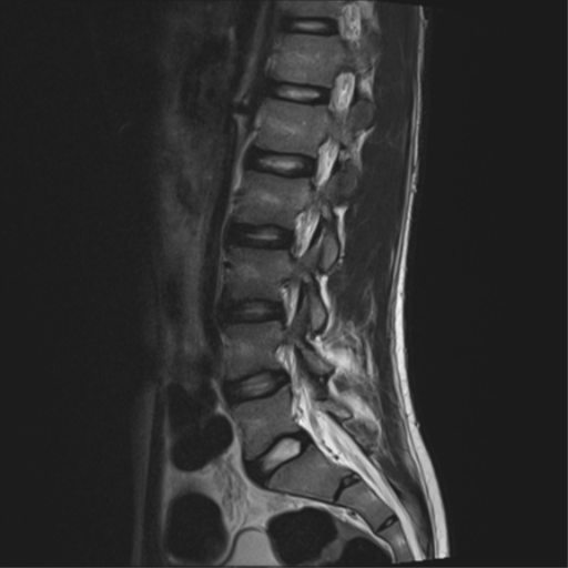 File:Clear cell meningoma - lumbar spine (Radiopaedia 60116-67690 Sagittal T2 11).png
