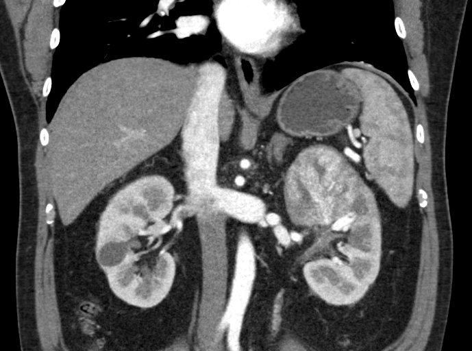 File:Clear cell renal cell carcinoma (Radiopaedia 61449-69393 C 18).jpg
