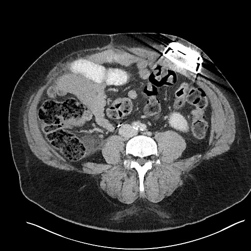 File:Closed loop obstruction - internal hernia into nephrectomy bed (Radiopaedia 59867-67320 Axial 30).jpg