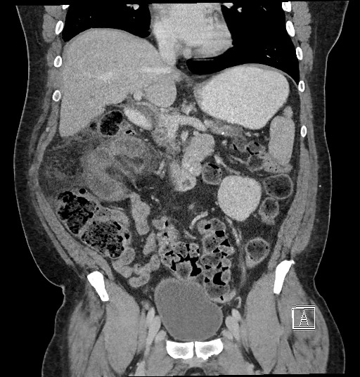 Closed loop obstruction - internal hernia into nephrectomy bed (Radiopaedia 59867-67320 B 62).jpg