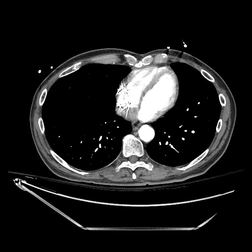 File:Closed loop obstruction due to adhesive band, resulting in small bowel ischemia and resection (Radiopaedia 83835-99023 Axial 362).jpg