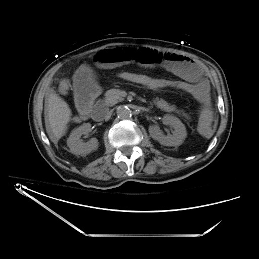 Closed loop obstruction due to adhesive band, resulting in small bowel ischemia and resection (Radiopaedia 83835-99023 Axial non-contrast 60).jpg