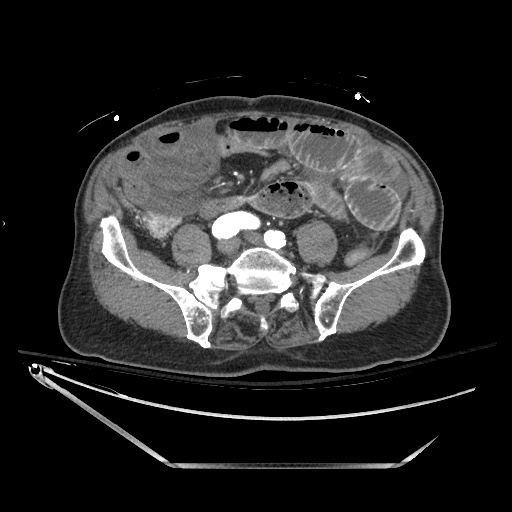 Closed loop obstruction due to adhesive band, resulting in small bowel ischemia and resection (Radiopaedia 83835-99023 B 104).jpg