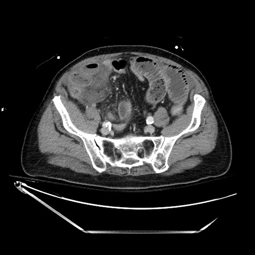 File:Closed loop obstruction due to adhesive band, resulting in small bowel ischemia and resection (Radiopaedia 83835-99023 D 115).jpg