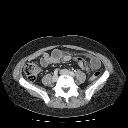 File:Closed loop small bowel obstruction (Radiopaedia 65403-74451 Axial 10).jpg