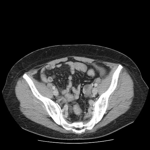 File:Closed loop small bowel obstruction (Radiopaedia 65403-74451 Axial 34).jpg