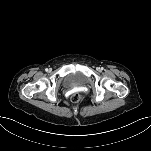 Closed loop small bowel obstruction - adhesive band with a C-shaped loop (Radiopaedia 83832-99018 A 127).jpg