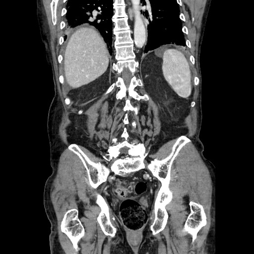 File:Closed loop small bowel obstruction - adhesive disease and hemorrhagic ischemia (Radiopaedia 86831-102990 B 96).jpg