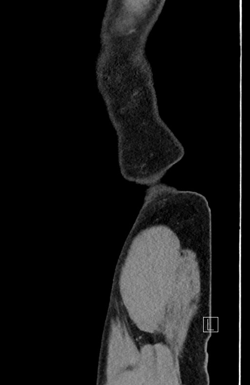 Closed loop small bowel obstruction - internal hernia (Radiopaedia 57806-64778 C 6).jpg