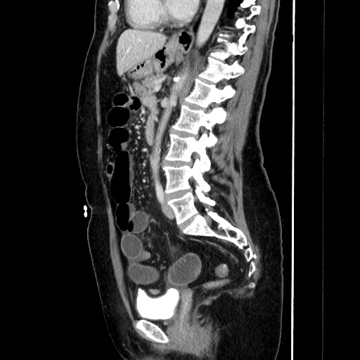 Closed loop small bowel obstruction due to adhesive bands - early and late images (Radiopaedia 83830-99015 C 100).jpg