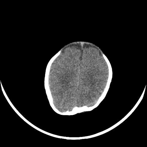 File:Cloverleaf shaped skull in the absence of craniosynostosis (Radiopaedia 21296-21216 Axial non-contrast 15).jpg
