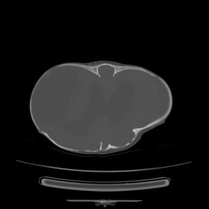 Cloverleaf skull (Radiopaedia 91901-109710 Axial bone window 107).jpg