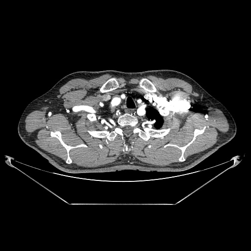 Coarctation of aorta (Radiopaedia 25384-25630 A 9).jpg