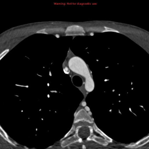 File:Coarctation of the aorta (Radiopaedia 12461-12697 A 69).jpg