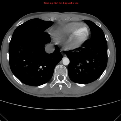 File:Coarctation of the aorta (Radiopaedia 9434-10118 A 148).jpg