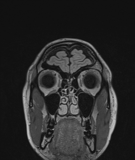 Colloid cyst (Radiopaedia 73154-83877 Coronal FLAIR 7).jpg