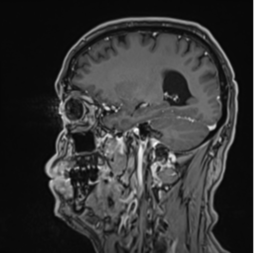 File:Colloid cyst of the third ventricle (Radiopaedia 86571-102662 Sagittal T1 C+ 53).png
