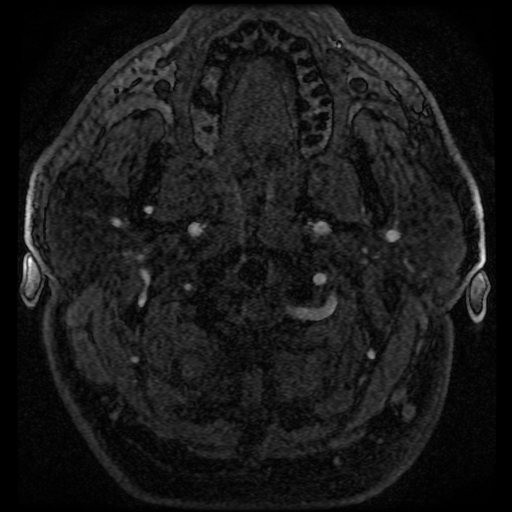 File:Colloid cyst with anterior communicating artery aneurysm (Radiopaedia 33901-35091 Axial MRA 14).jpg