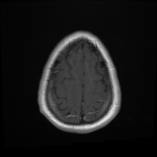 File:Colloid cyst with anterior communicating artery aneurysm (Radiopaedia 33901-35091 Axial T1 25).jpg