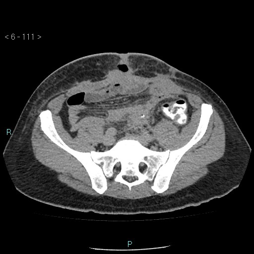 Colo-cutaneous fistula (Radiopaedia 40531-43129 A 46).jpg