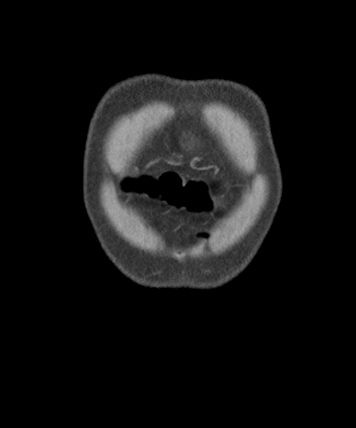 Colon adenocarcinoma - splenic flexure (Radiopaedia 34143-35406 B 7).png