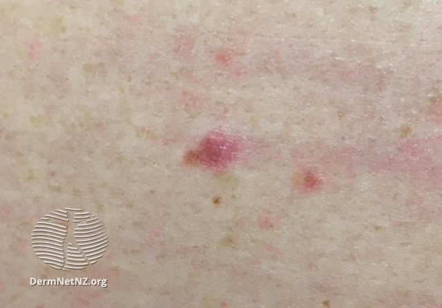 File:Macro image of amelanotic melanoma 2 (DermNet NZ amelanotic-melanoma1-macro).jpg