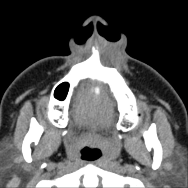 Nasolabial cyst (Radiopaedia 33987-35205 Axial non-contrast 6).jpg