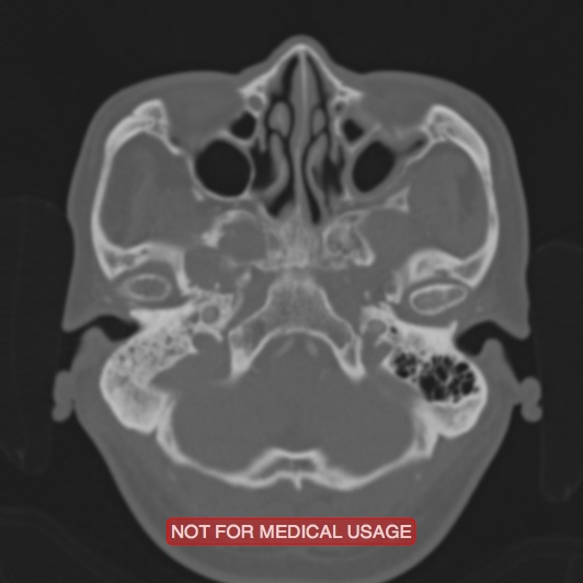 Nasopharyngeal carcinoma recurrence - skull base destruction (Radiopaedia 29107-29490 Axial bone window 89).jpg