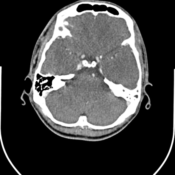 Nasopharyngeal carcinoma with skull base invasion (Radiopaedia 53415-59705 A 2).jpg