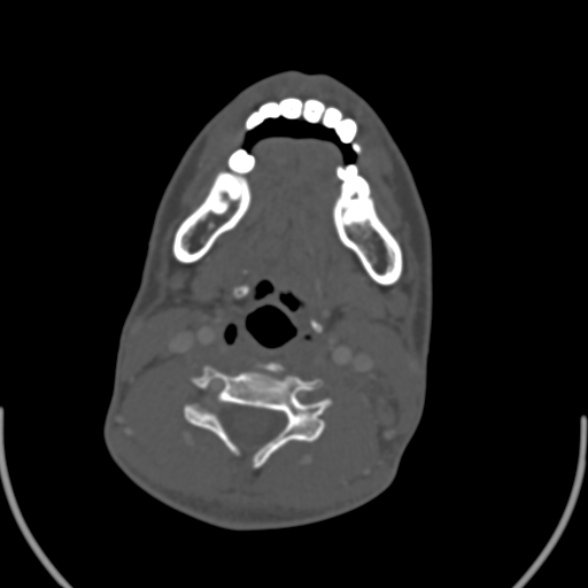 Nasopharyngeal carcinoma with skull base invasion (Radiopaedia 53415-59705 Axial bone window 122).jpg