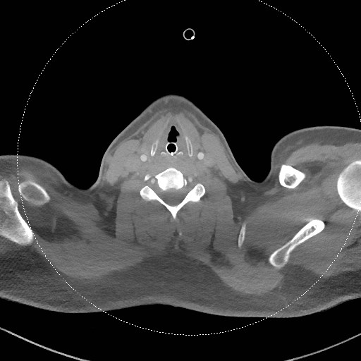 Neck CT angiogram (intraosseous vascular access) (Radiopaedia 55481-61945 B 156).jpg