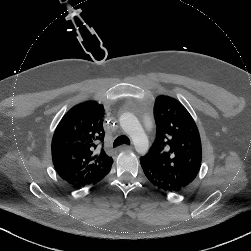 Neck CT angiogram (intraosseous vascular access) (Radiopaedia 55481-61945 B 50).jpg