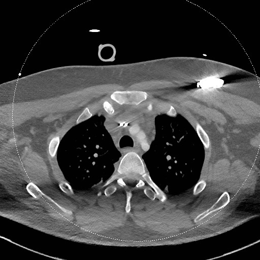 Neck CT angiogram (intraosseous vascular access) (Radiopaedia 55481-61945 B 63).jpg