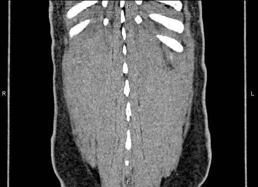 Necrotizing pancreatitis (Radiopaedia 87796-104248 F 65).jpg