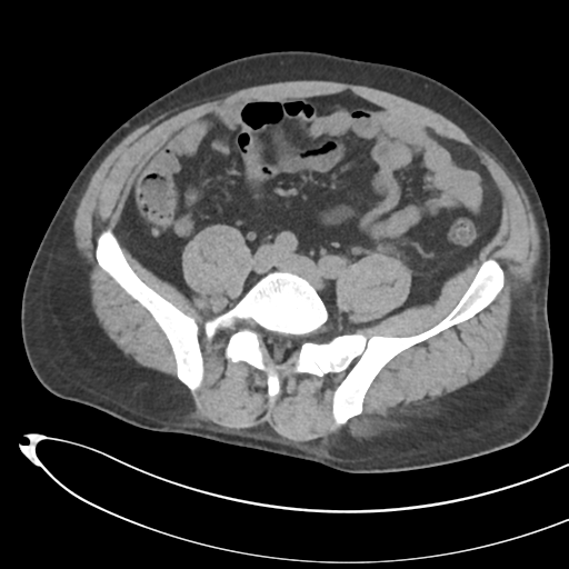 File:Necrotizing pancreatitis with acute necrotic collections (Radiopaedia 38829-41012 Axial non-contrast 57).png